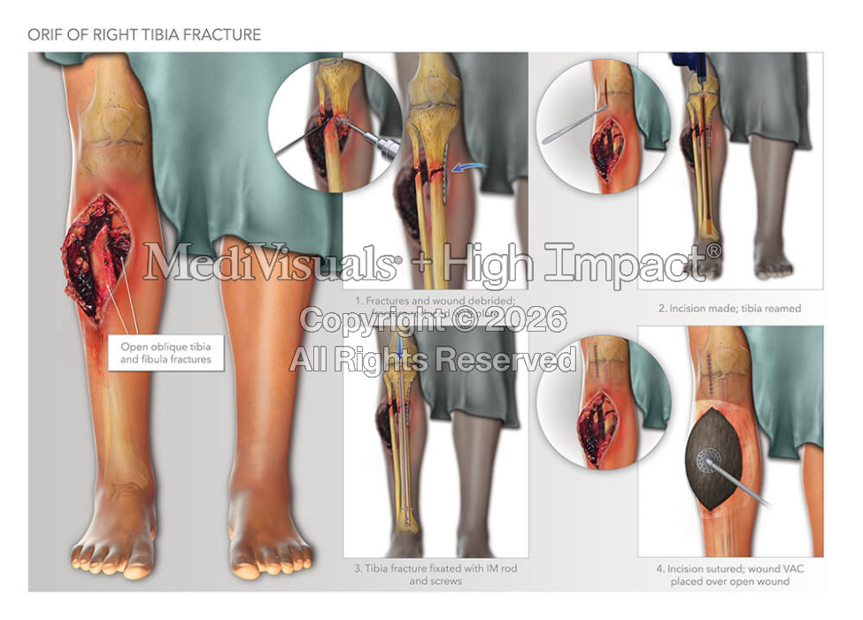 ORIF of Right Tibia Fracture