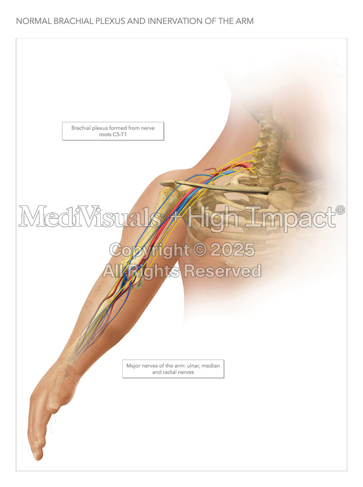 $8.9M Verdict: Baby’s Brachial Plexus Destroyed During Mishandled Shoulder Dystocia