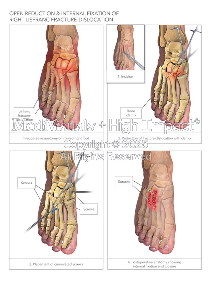 ORIF & Internal Fixation of Right Lisfranc Fracture-Dislocation