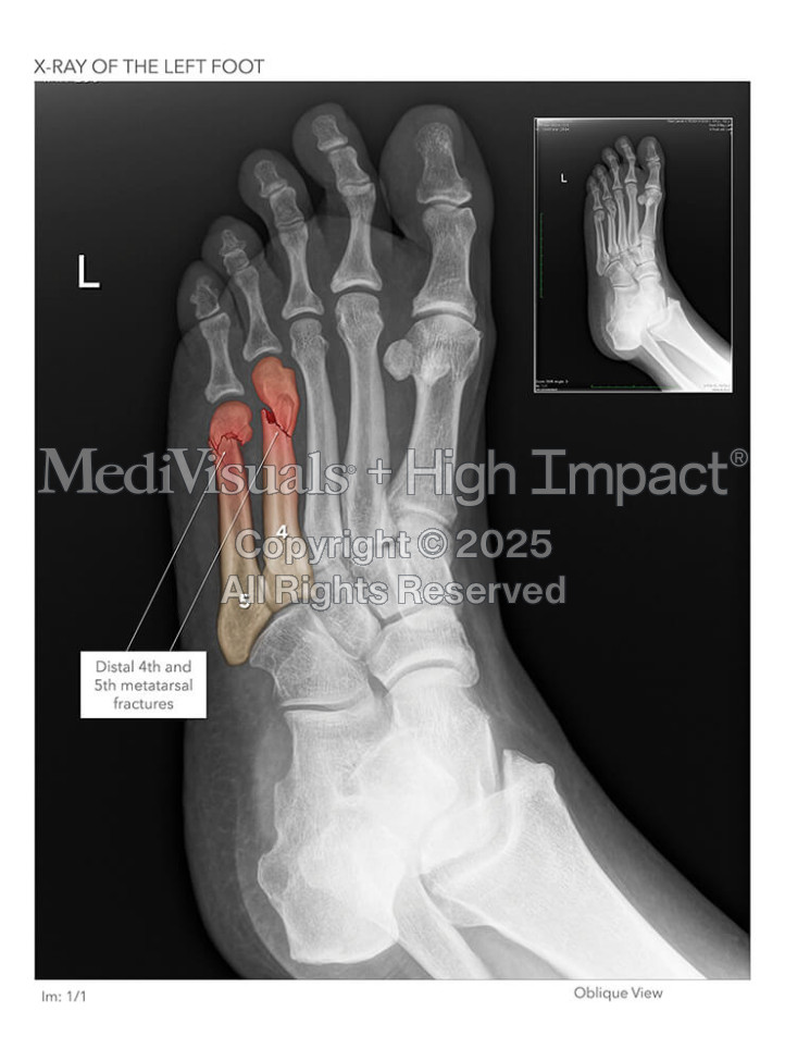 X-ray of the Left Foot