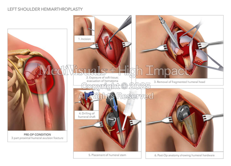 Left Shoulder Hemiarthroplasty