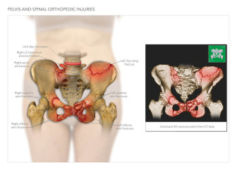 Pelvis and Spinal Orthopedic Injuries