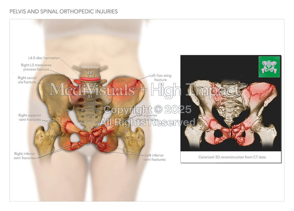 Pelvis and Spinal Orthopedic Injuries