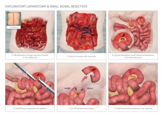Exploratory Laparotomy and Bowel Resection