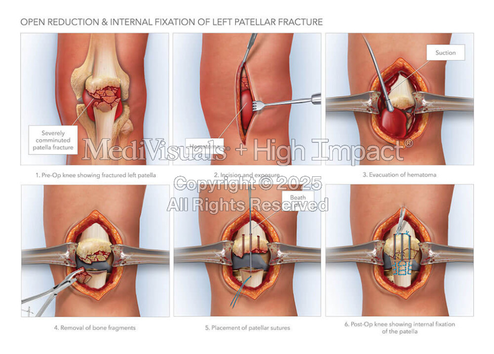 ORIF of Left Patellar Fracture