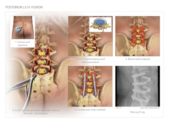 Posterior L3–S1 Fusion