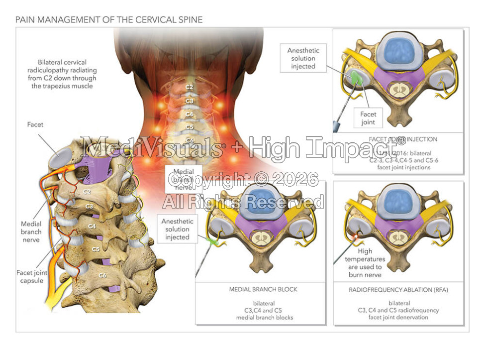 Pain Management of The Cervical Spine