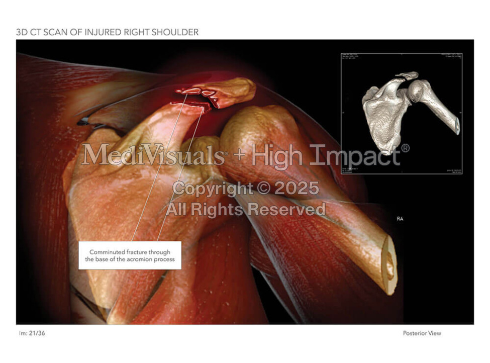 3D CT Scan of Injured & Repaired Right Shoulder