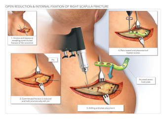 ORIF of Right Scapula Fracture