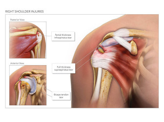 Right Shoulder Injuries