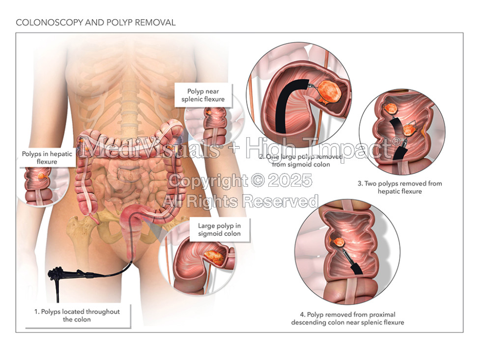 Colonoscopy and Polyp Removal