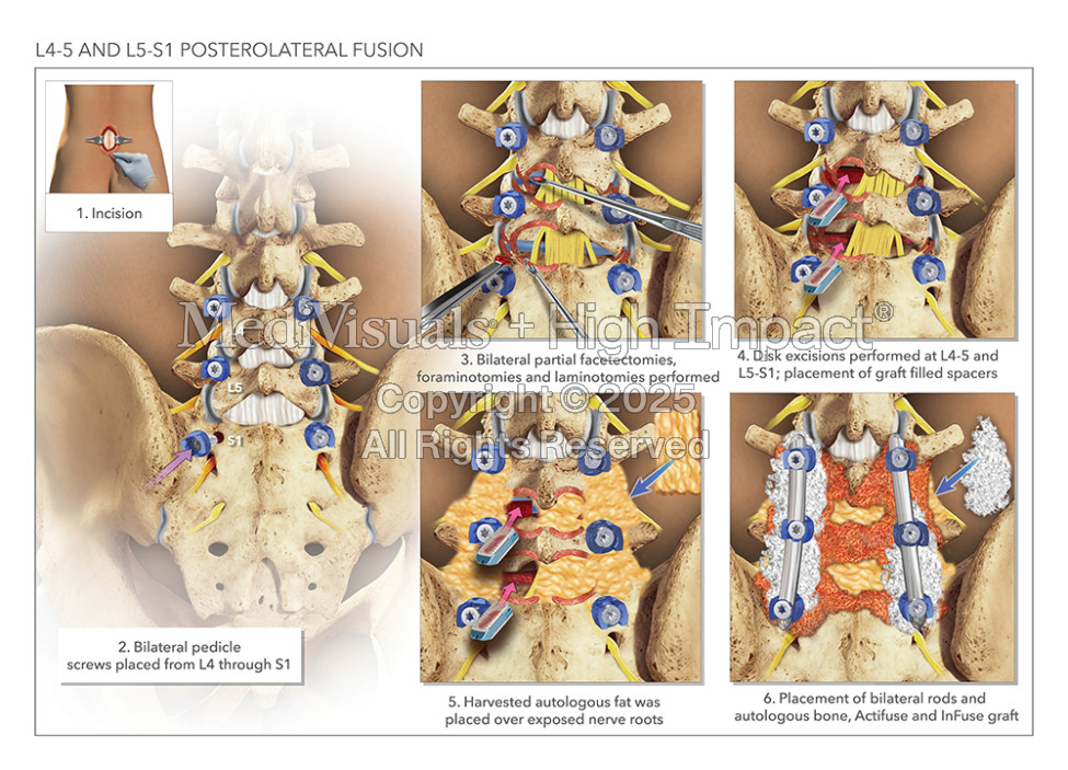 L4-5 and L5-S1 Posterolateral Fusion