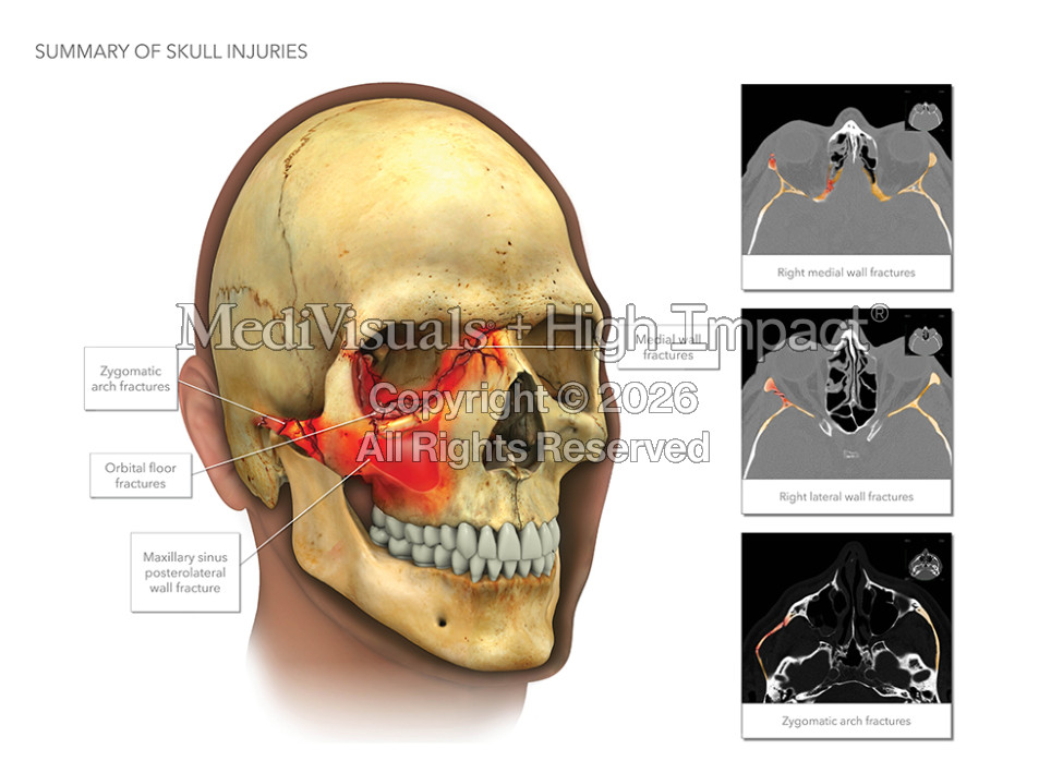 Skull Fracture Injury Summary