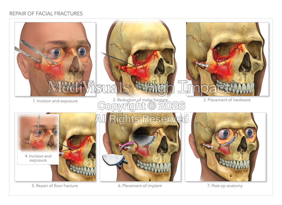 Repair of Facial Fractures