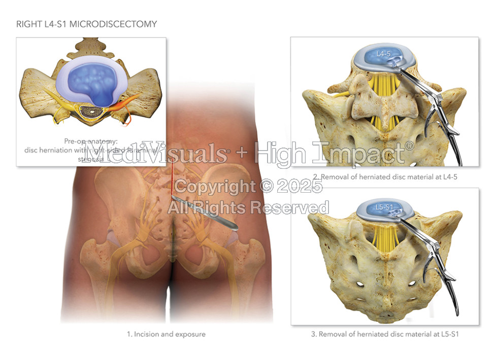 L4-S1 Microdiscectomy