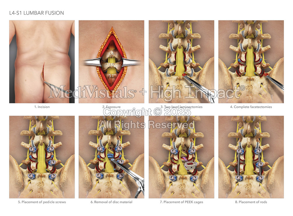 L4-S1 Lumbar Fusion