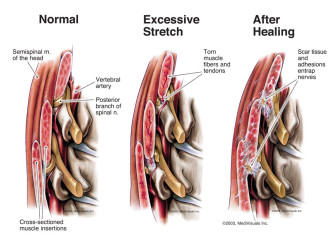 Cervical Spine Muscular Strain