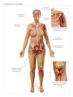 Illustrated Injury Summary
