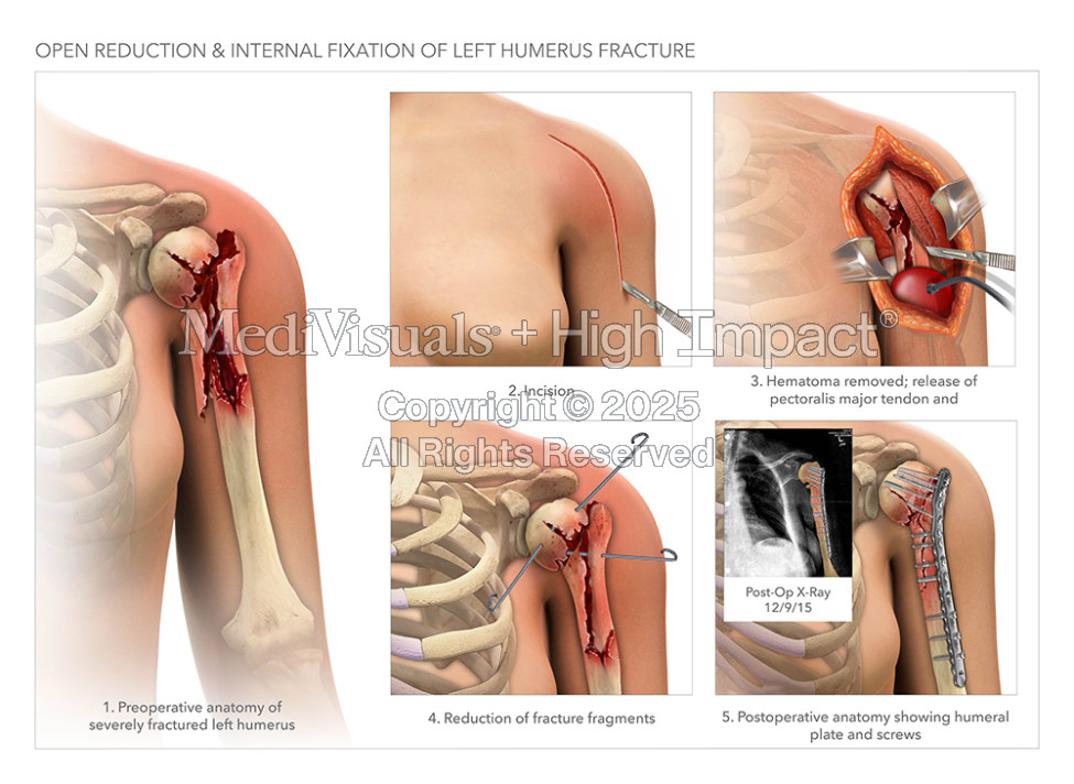 Open Reduction Internal Fixation of Left Humerus Fracture