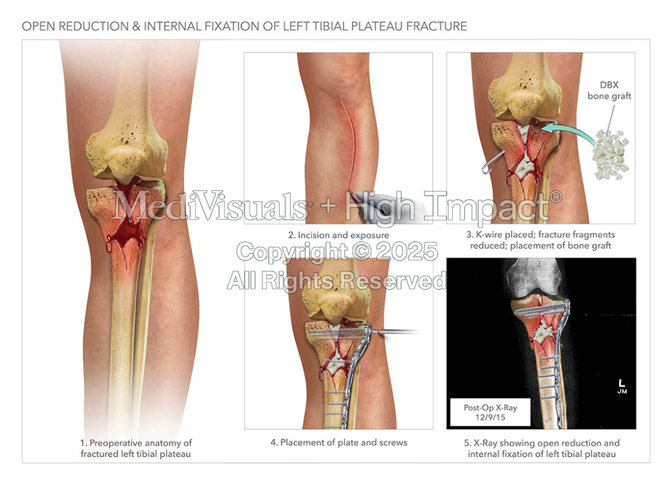 Open Reduction Internal Fixation of Tibial Plateau Fracture