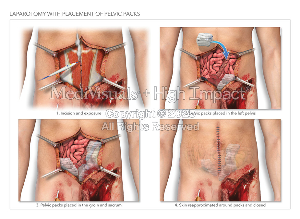 Laparotomy with Placement of Pelvic Packs