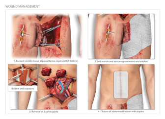 Wound Management