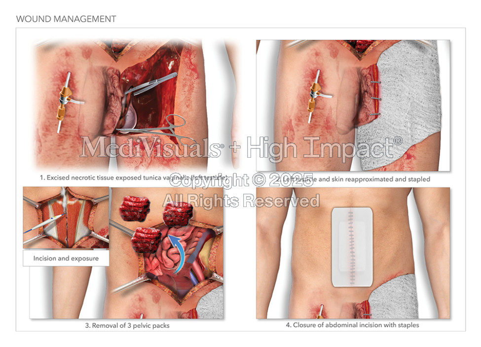 Wound Management
