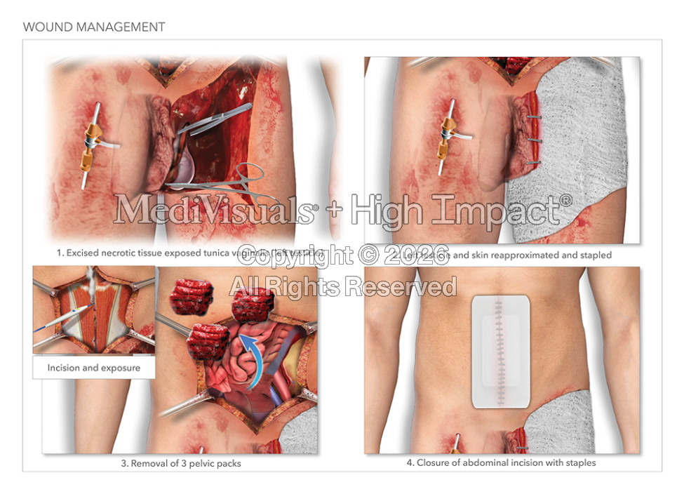 Wound Management