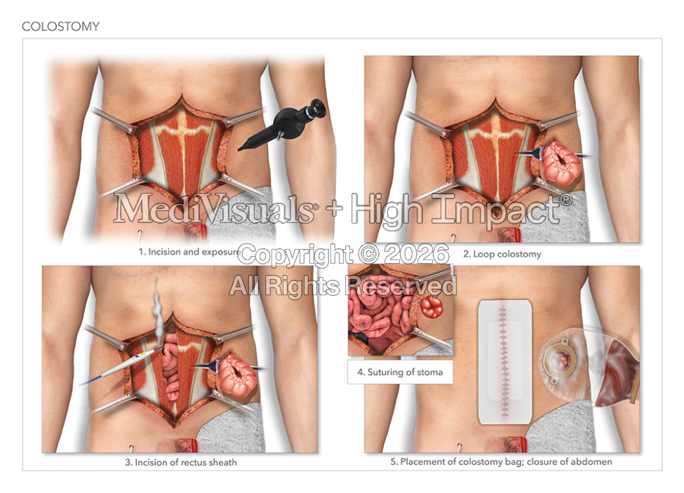 Colostomy