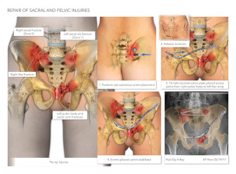 Repair of Sacral and Pelvic Injuries