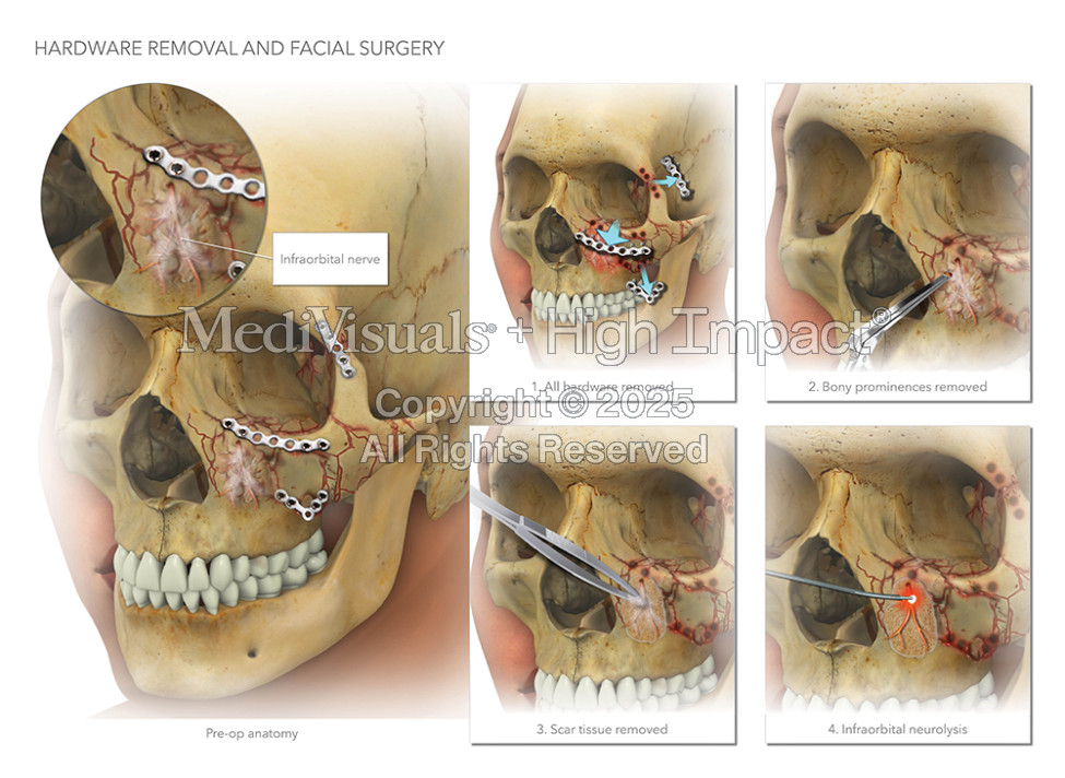 Hardware Removal and Facial Surgery