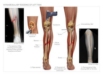 Intramedullary Rodding of the Left Tibia