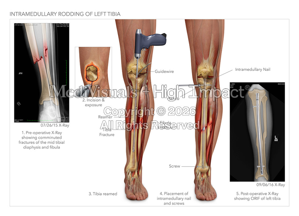 Intramedullary Rodding of the Left Tibia
