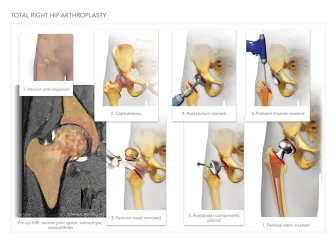 Hip Injuries with Replacement