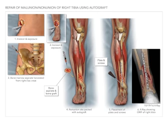 Repair of Tibial Nonunion