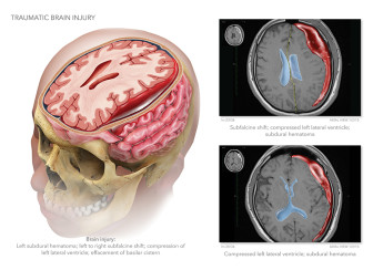 Traumatic Brain Injury