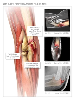 Hamstring Tendon Avulsion