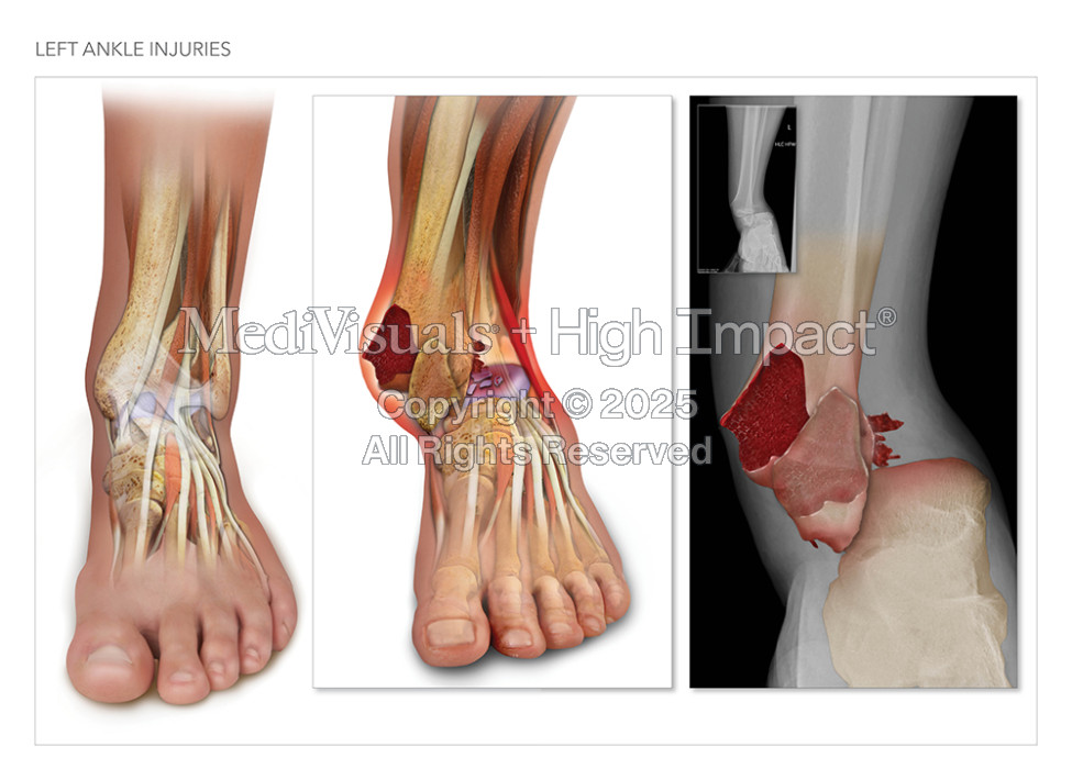 Left Ankle Injuries