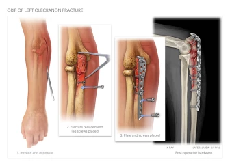 Open Reduction Internal Fixation of Olecranon Fracture