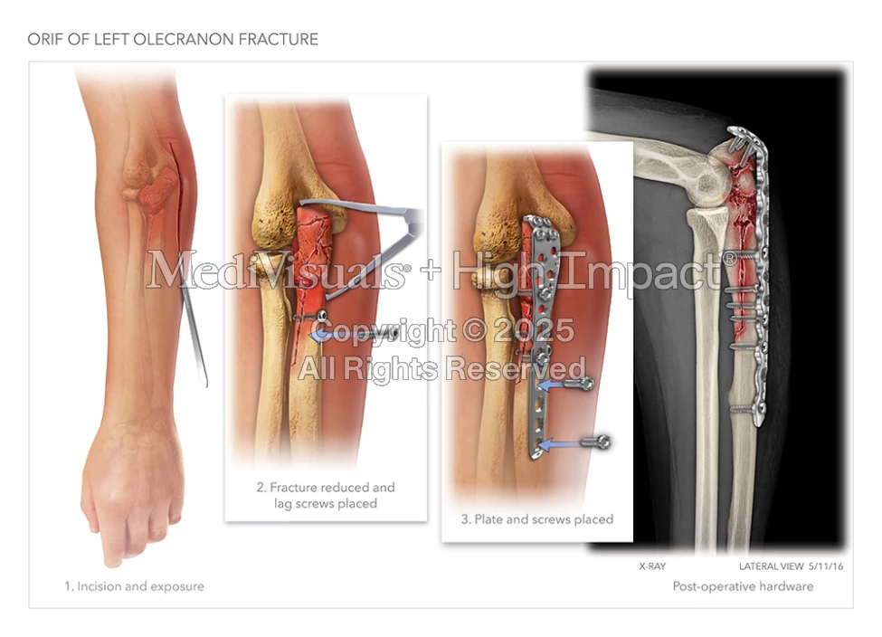 Open Reduction Internal Fixation of Olecranon Fracture | MediVisuals ...