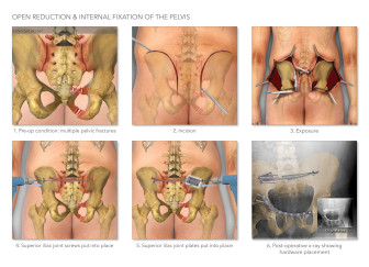Open Reduction Internal Fixation of the Pelvis