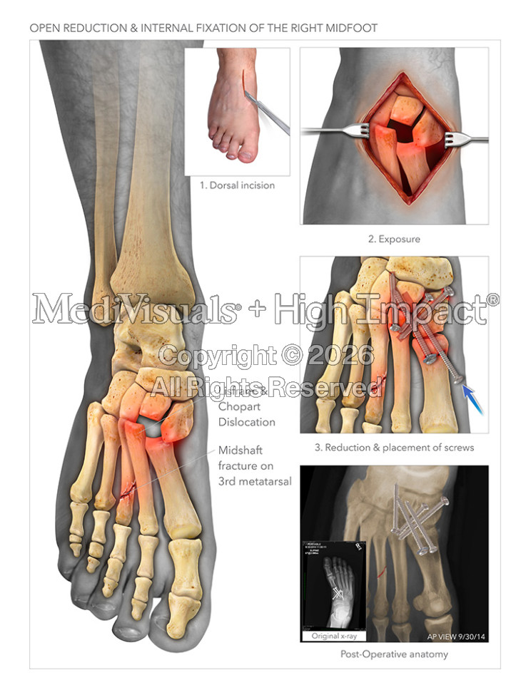 Open Reduction Internal Fixation of the Midfoot