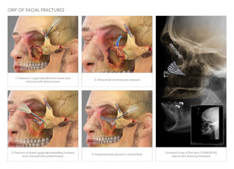 Open Reduction Internal Fixation of Facial Fractures