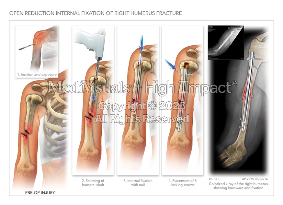 Open Reduction Internal Fixation of Right Humerus Fracture