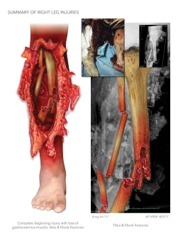 Summary of Right Leg Injuries