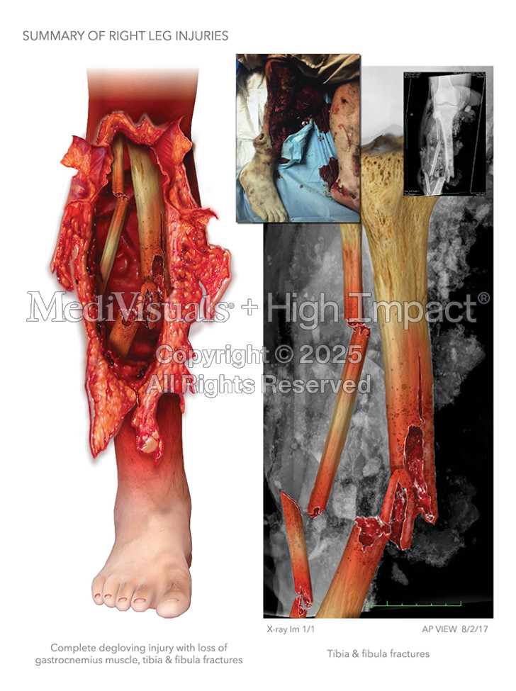 Summary of Right Leg Injuries
