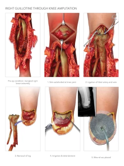 Guillotone Through Knee Amputation