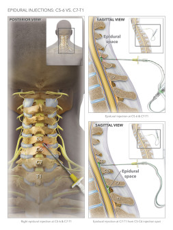 Epidural Injections C5-6 vs. C7-T1