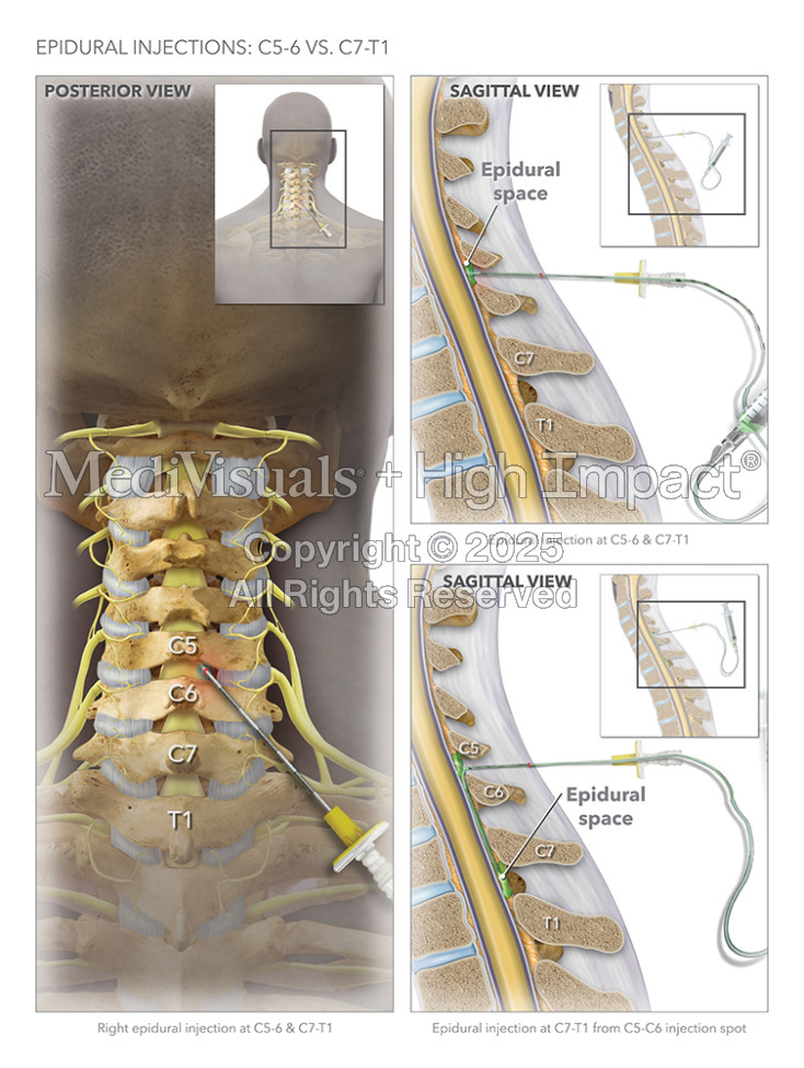 Epidural Injections C5-6 vs. C7-T1