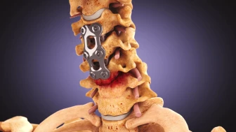 Summary of Cervical Spine Injuries